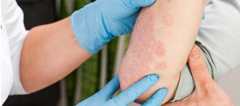 Argentina acaba de aprobar un medicamento para combatir la psoriasis: de qué se trata